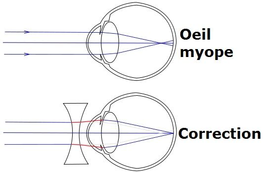 Myopie