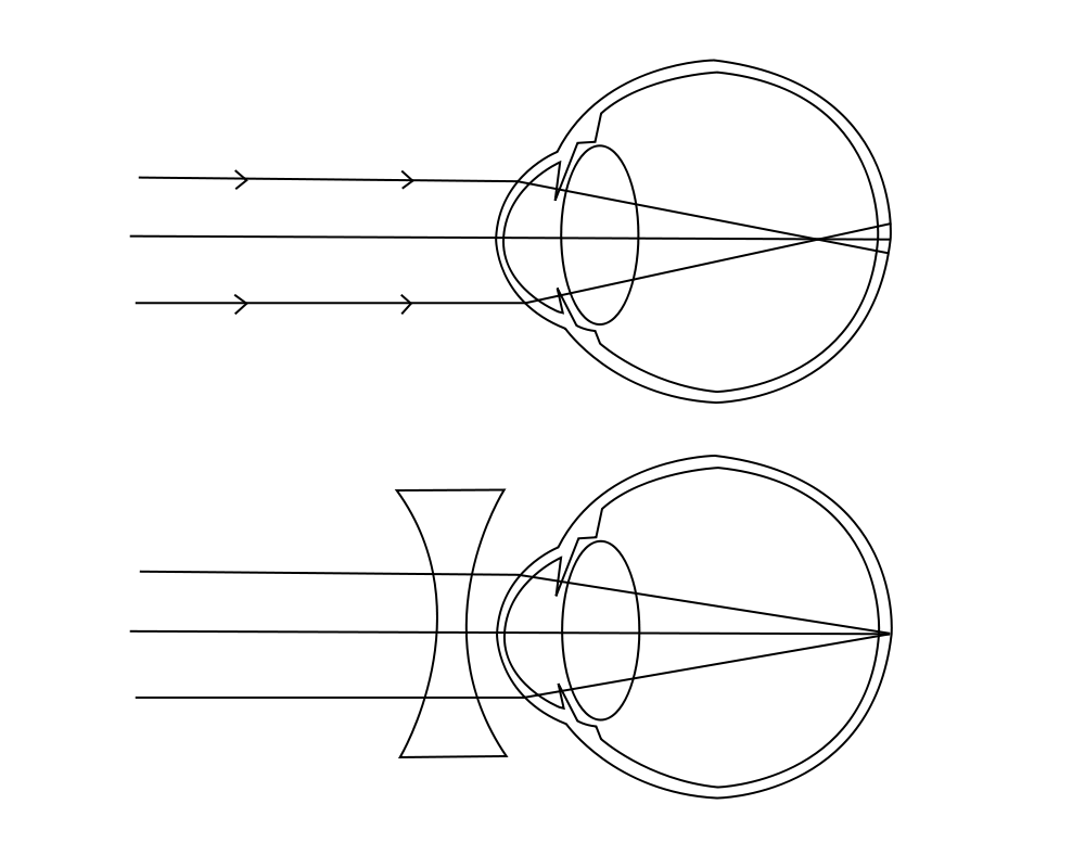 A diagram of a myopic eye (top) and myopic eye corrected by a diverging lens (bottom).